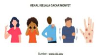 KENALI GEJALA CACAR MONYET
