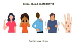 KENALI GEJALA CACAR MONYET