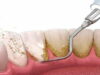Cara Bersihkan Karang Gigi dengan Scaling di Puskesmas Lebih Murah Bisa dengan BPJS