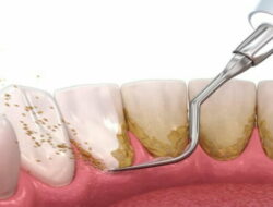 Cara Bersihkan Karang Gigi dengan Scaling di Puskesmas Lebih Murah Bisa dengan BPJS